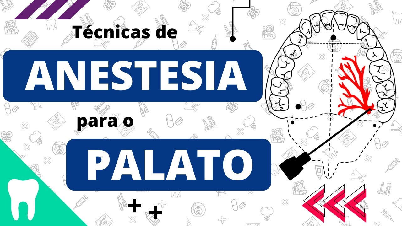 TÉCNICAS ANESTÉSICAS PARA MAXILA | PARTE 2