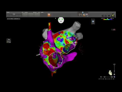 Persistent atrial fibrillation catheter ablation