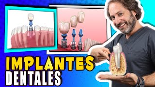 🎯 𝐂𝐨𝐥𝐨𝐜𝐚𝐜𝐢𝐨𝐧 de 𝐈𝐌𝐏𝐋𝐀𝐍𝐓𝐄𝐒 𝐃𝐄𝐍𝐓𝐀𝐋𝐄𝐒 Paso a Paso  ¿Cuantos Implantes Dentales se Pueden Poner