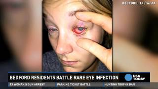 Rare eye parasite causes sharp pain in those infected