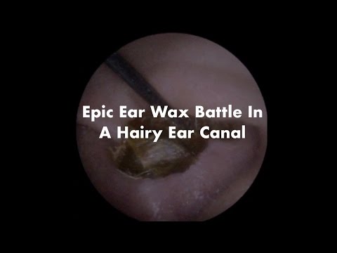 Epic Ear Wax Removal In Hairy Ear Canal - Ep 10