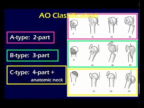 Proximal Humerus Fractures 1 (OTA lecture series III u03a)