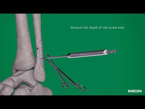 Inion Freedom™ System - Ankle Fracture Repair Animation