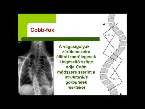 kenőcső könyökfájdalomra