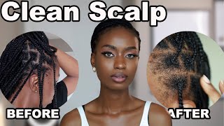 HOW GET RID OF FLAKY SCALP, ITCHY SCALP,  DANDRUFF WITHOUT WASHING BRAIDS