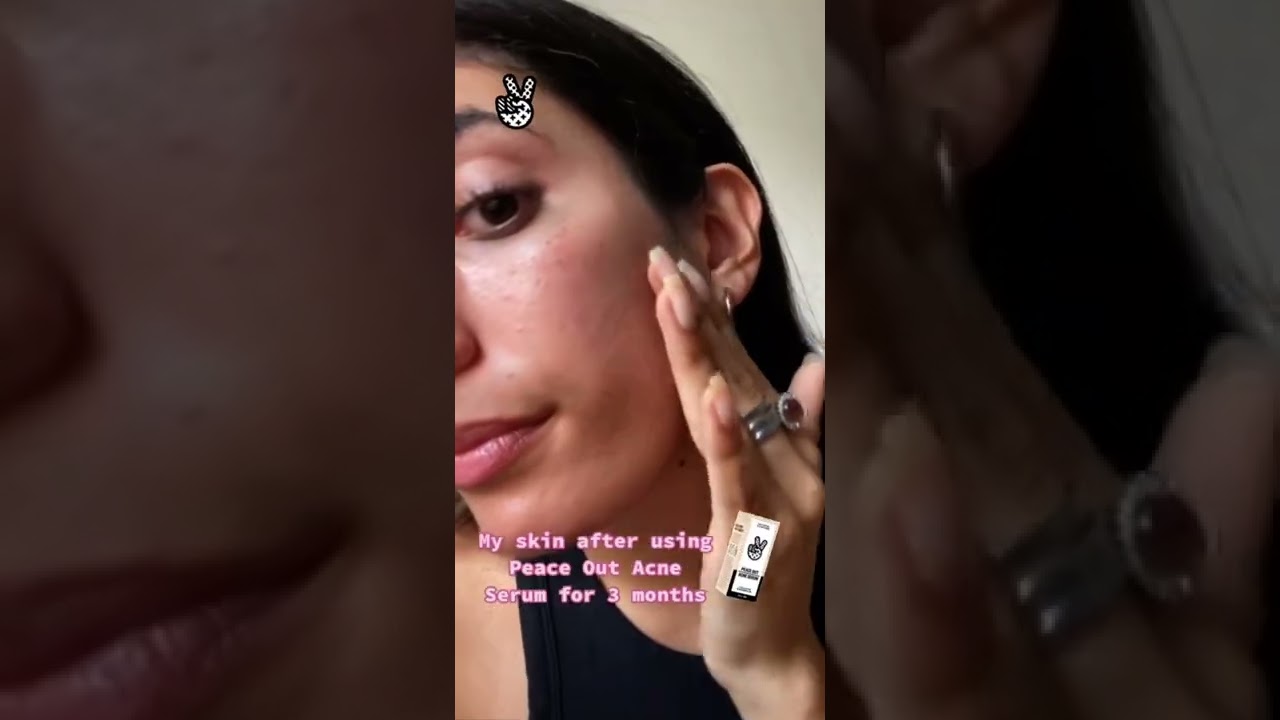 Peace Out - Acne Serum