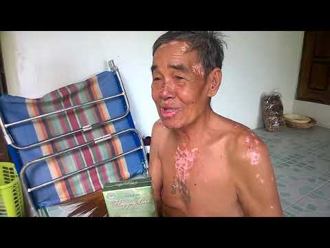 มนุษย์ papilloma ไวรัสและโรคสะเก็ดเงิน โรคสะเก็ดเงินในจอร์เจีย