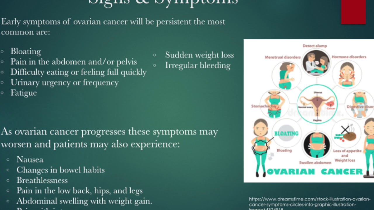 Ovarian Cancer PowerPoint.