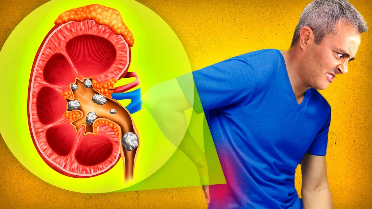 TIVE PEDRAS NO RIM! A pior dor que um ser humano pode sentir