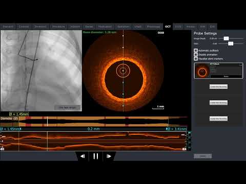 Mentice: Prepare for the Complexities of Post-TAVI PCI with the Updated Coronary Intermediate Module