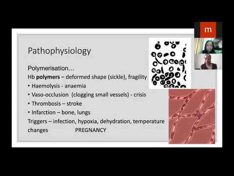 Managing Sickle Cell Disease in Pregnancy: What Can we Do Better?