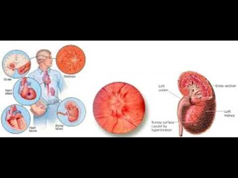 Pelure doignon dans la médecine populaire pour lhypertension Prix VALZ à Moscou