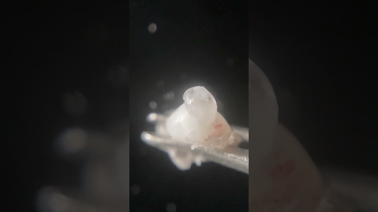 vol.17 "Moving" dandruff and scab picture book　動くフケ・角栓図鑑。#shorts