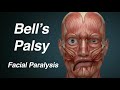 Bell's Palsy (One Sided Facial Paralysis)