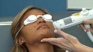 New Acne Laser for Darker Skin?