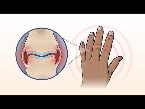 What Is Rheumatoid Arthritis? | NEJM