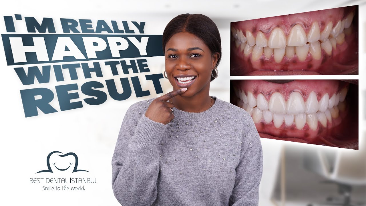 "From Denmark to Istanbul: Transforming My Smile at the Best Dental Clinic!"