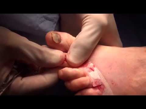 Ask Dr Moore Foot and Ankle FAQ Frequently Asked Questions Video Offering