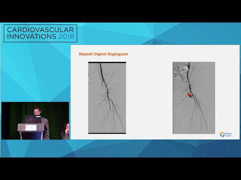 CVI2018 Session: My worst SFA complication - Justin Dunn, MD