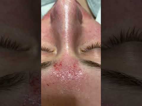 MicroChanneling 🔥 MicroNeedling