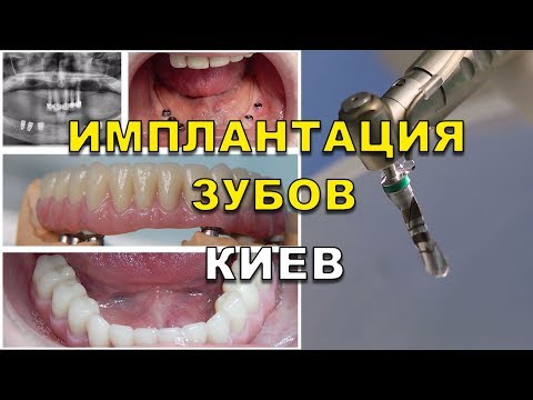 Вставить зуб киев
