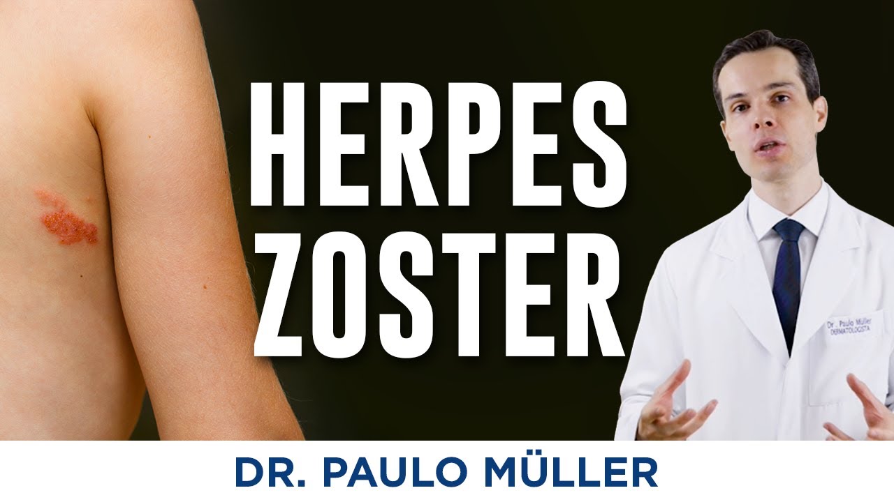 Herpes Zoster - O que é? Como tratar? - Dr. Paulo Müller Dermatologista