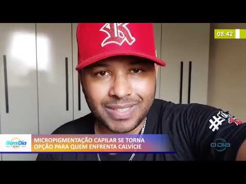 Micropigmentação capilar se torna opção para quem enfrenta calvície 04 01 2021