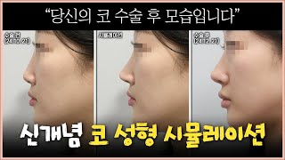 코 성형 시뮬레이션, 포토샵 결과와 실제 수술 결과 비교해봤습니다!!