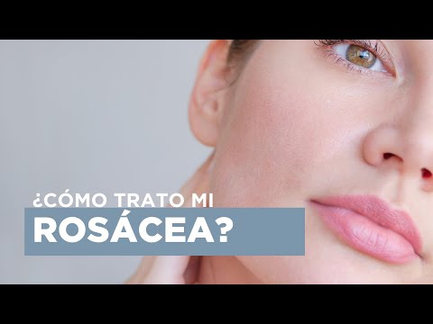 ¿Por qué tengo rosácea y cómo puedo tratarla?