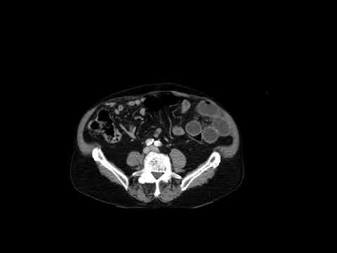 Closed Loop Small Bowel Obstruction
