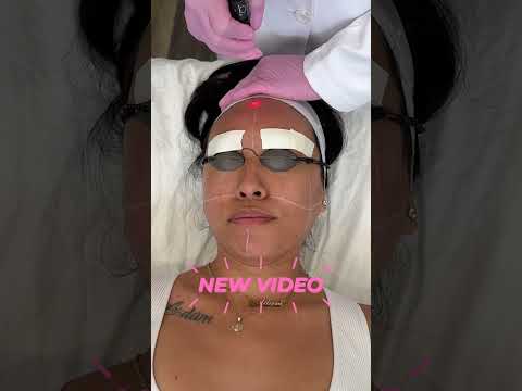 LaserAway's "lunchtime" facial: Instant Glow, the...