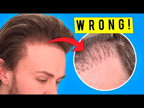 7 Reasons Why Hair Transplants Fail