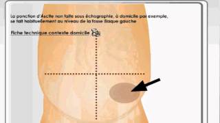 Ponction d'ascite