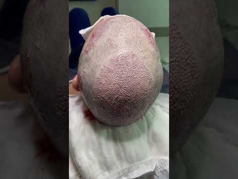 Crown restoration with hair transplant #пересадкаволос...