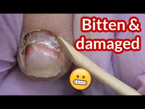 Fixing Bitten Overfiled Nails With Acrylic Nail Extensions on Forms