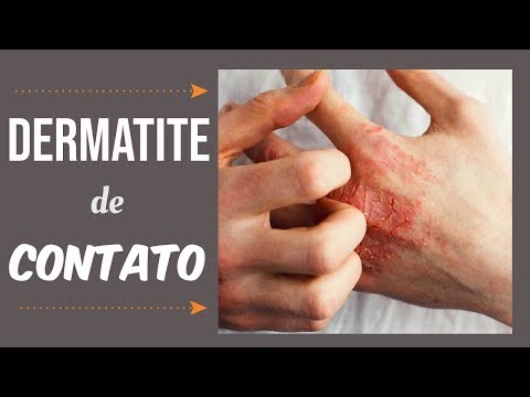 Psoríase de forma de lágrima Se transferência para a reserva de exército com eczema