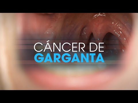 Throat cancer | Patients TV