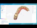 DS Core - Plan Features: CEREC on DS Core – Remove excessive scan data with cut tool