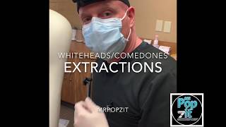Whiteheads and comedones for days. Extractions. Cyst pops. Big squeeze. Juicy pops. MrPopZit.