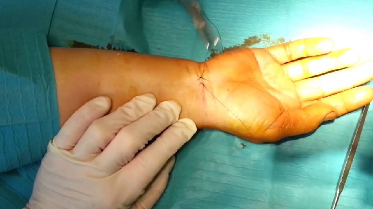 Watch Now Sindrome del Tunnel Carpale: trattamento chirurgico mininvasivo Sindrome del Tunnel Carpale: trattamento chirurgico mininvasivo
