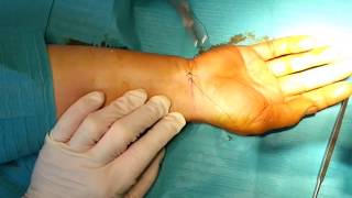 Sindrome del Tunnel Carpale: trattamento chirurgico mininvasivo