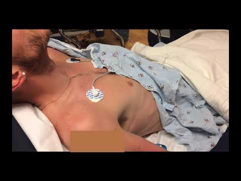 Kussmaul Breathing in Diabetic Ketoacidosis (DKA)