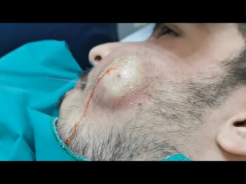 Dental Abscess Incision and Drainage