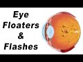 Glaucoma, Cataracts, & Eye Floaters