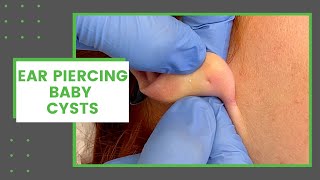 Ear Piercing Baby Cysts | Dr. Derm