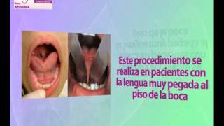 ¿Qué es la Frenectomía