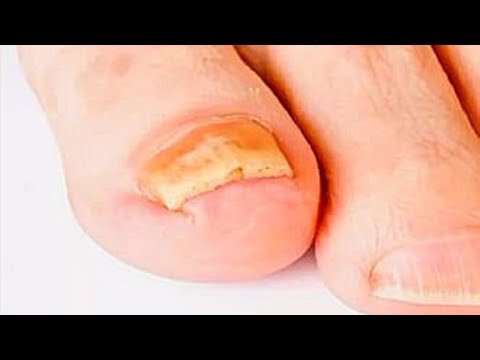 Mikosan in chabarowske zu kaufen Scholl das Mittel von gribka der Nägel zu kaufen,