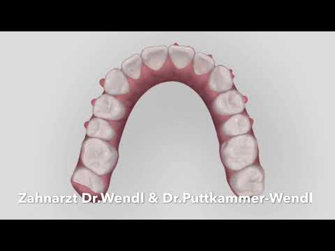 Beispiel einer Alignertherapie