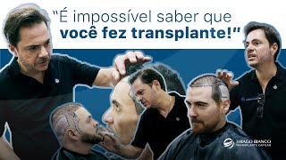 Primeira cirurgia ou correção? Veja casos reais de Transplante Capilar | Dr. Thiago Bianco