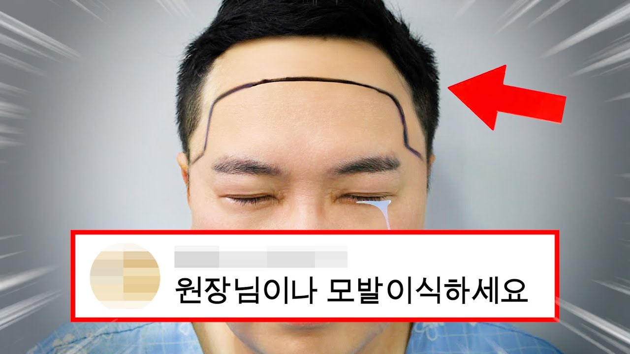 두번째 모발이식 했습니다!
